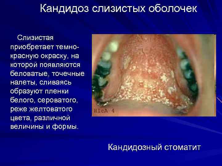 Кандидоз слизистых оболочек Cлизистая приобретает темнокрасную окраску, на которой появляются беловатые, точечные налеты, сливаясь