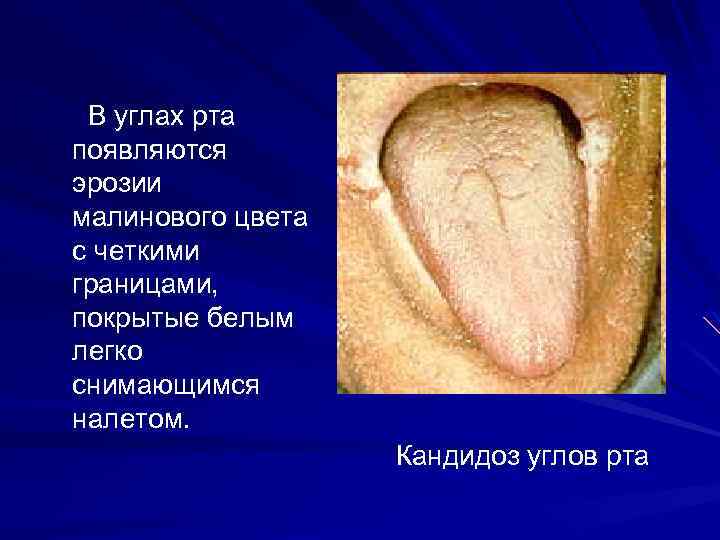 В углах рта появляются эрозии малинового цвета с четкими границами, покрытые белым легко снимающимся