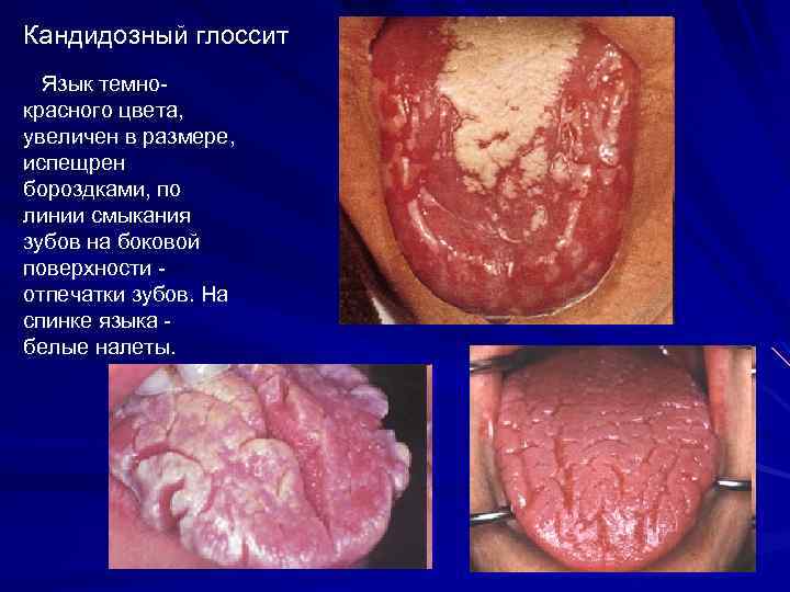 Кандидозный глоссит Язык темнокрасного цвета, увеличен в размере, испещрен бороздками, по линии смыкания зубов