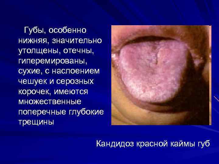 Губы, особенно нижняя, значительно утолщены, отечны, гиперемированы, сухие, с наслоением чешуек и серозных корочек,