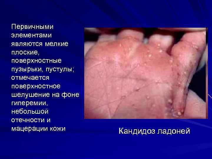 Первичными элементами являются мелкие плоские, поверхностные пузырьки, пустулы; отмечается поверхностное шелушение на фоне гиперемии,