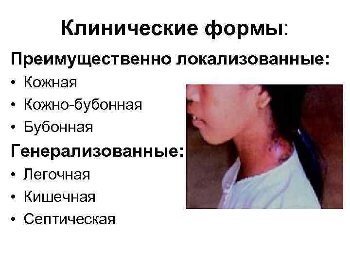 Клинические формы: Преимущественно локализованные: • Кожная • Кожно-бубонная • Бубонная Генерализованные: • Легочная •