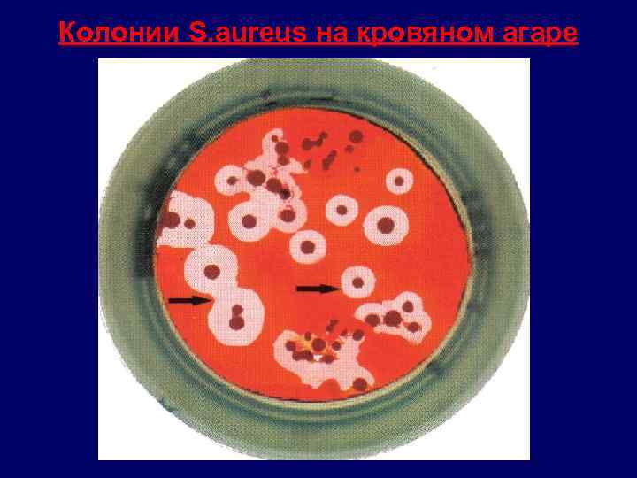 Колонии S. aureus на кровяном агаре 