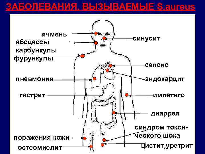 ЗАБОЛЕВАНИЯ, ВЫЗЫВАЕМЫЕ S. aureus ячмень абсцессы карбункулы фурункулы пневмония гастрит синусит сепсис эндокардит импетиго