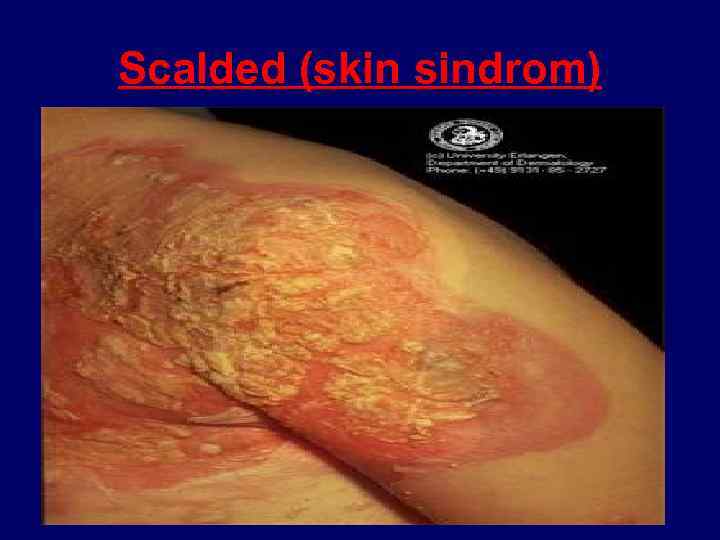 Scalded (skin sindrom) 