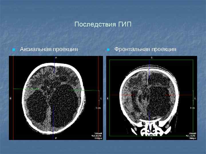 Последствия ГИП n Аксиальная проекция n Фронтальная проекция 
