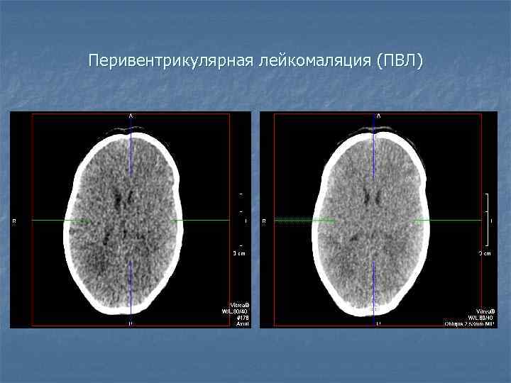 Перивентрикулярная лейкомаляция (ПВЛ) 