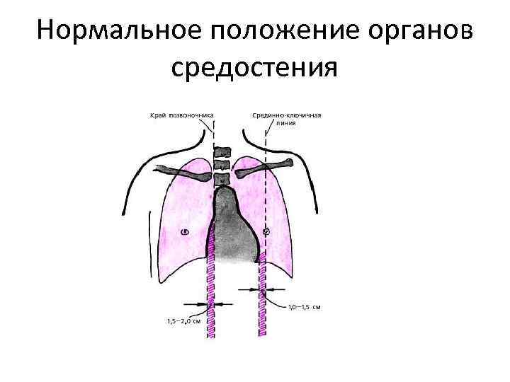 Нормальное положение органов средостения 