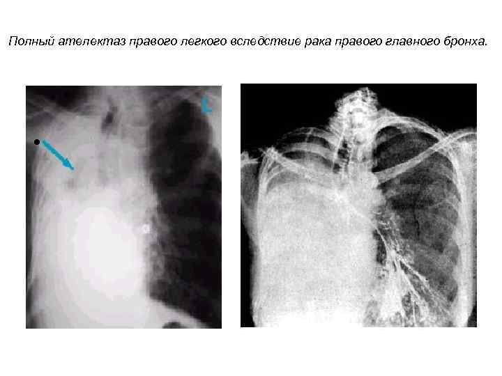 Полный ателектаз правого легкого вследствие рака правого главного бронха. • 