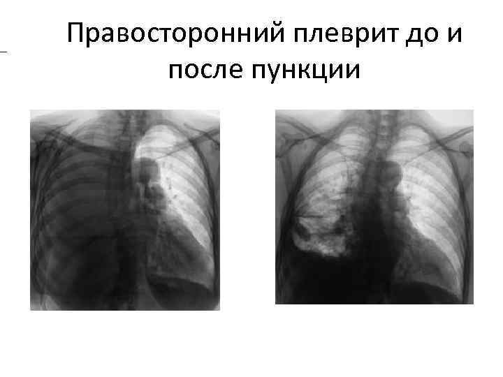  Правосторонний плеврит до и после пункции 