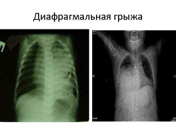 Диафрагмальная грыжа 