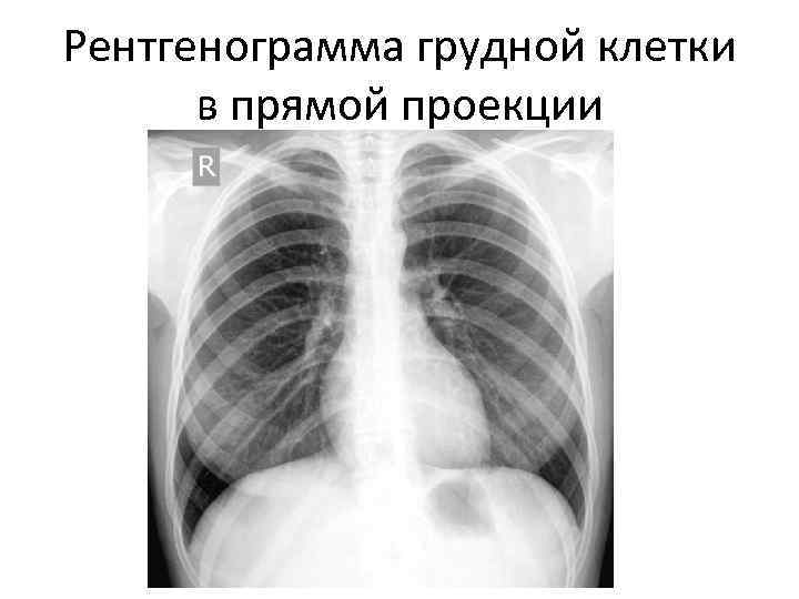 Рентгенограмма грудной клетки в прямой проекции 