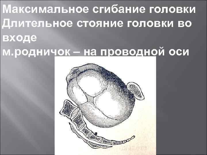 Максимальное сгибание головки Длительное стояние головки во входе м. родничок – на проводной оси