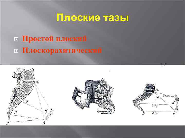 Плоские тазы Простой плоский Плоскорахитический 