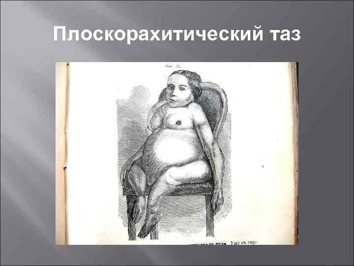 Плоскорахитический таз 