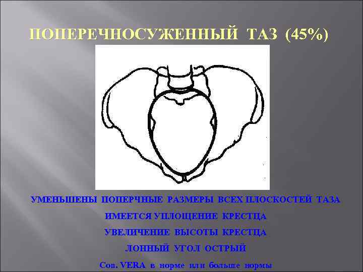 ПОПЕРЕЧНОСУЖЕННЫЙ ТАЗ (45%) УМЕНЬШЕНЫ ПОПЕРЧНЫЕ РАЗМЕРЫ ВСЕХ ПЛОСКОСТЕЙ ТАЗА ИМЕЕТСЯ УПЛОЩЕНИЕ КРЕСТЦА УВЕЛИЧЕНИЕ ВЫСОТЫ