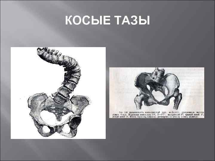 КОСЫЕ ТАЗЫ 