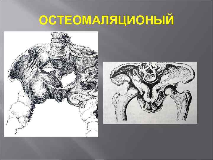 ОСТЕОМАЛЯЦИОНЫЙ 