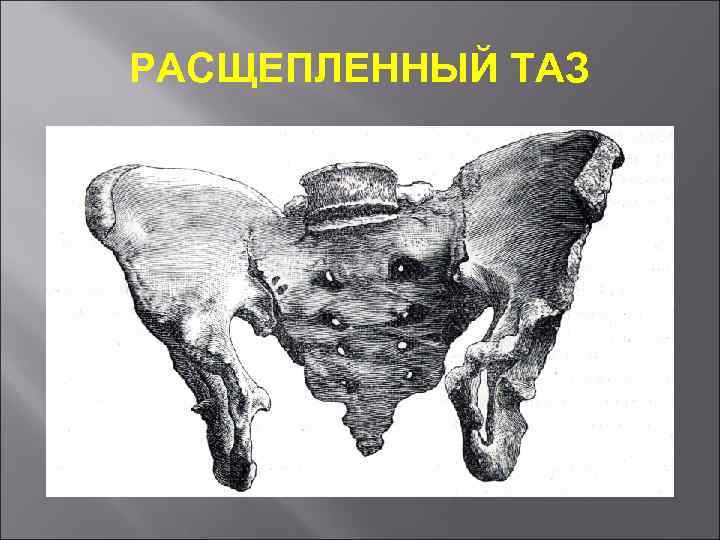 РАСЩЕПЛЕННЫЙ ТАЗ 