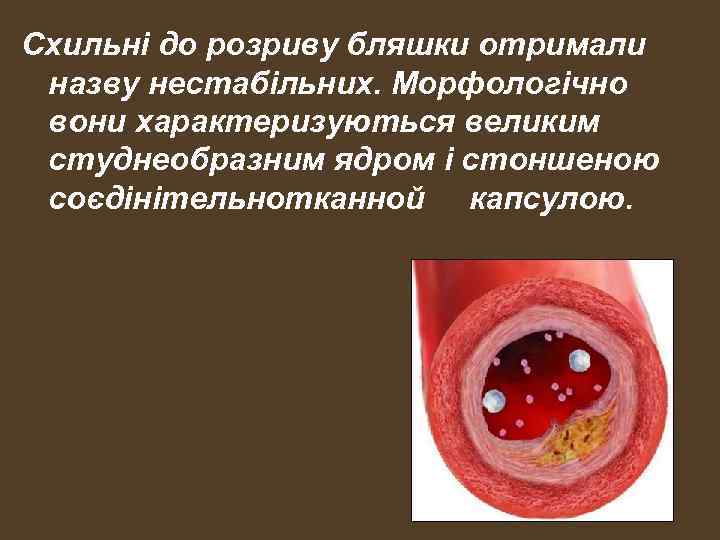 Схильні до розриву бляшки отримали назву нестабільних. Морфологічно вони характеризуються великим студнеобразним ядром і