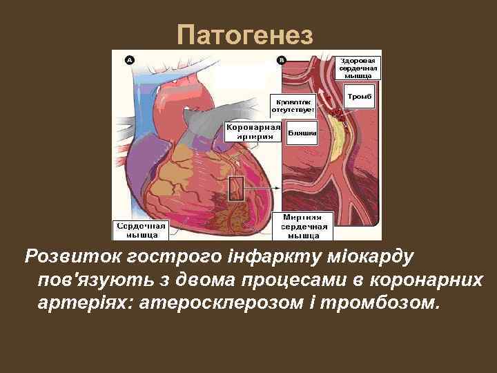 Патогенез Розвиток гострого інфаркту міокарду пов'язують з двома процесами в коронарних артеріях: атеросклерозом і