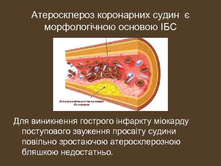 Атеросклероз коронарних судин є морфологічною основою ІБС Для виникнення гострого інфаркту міокарду поступового звуження