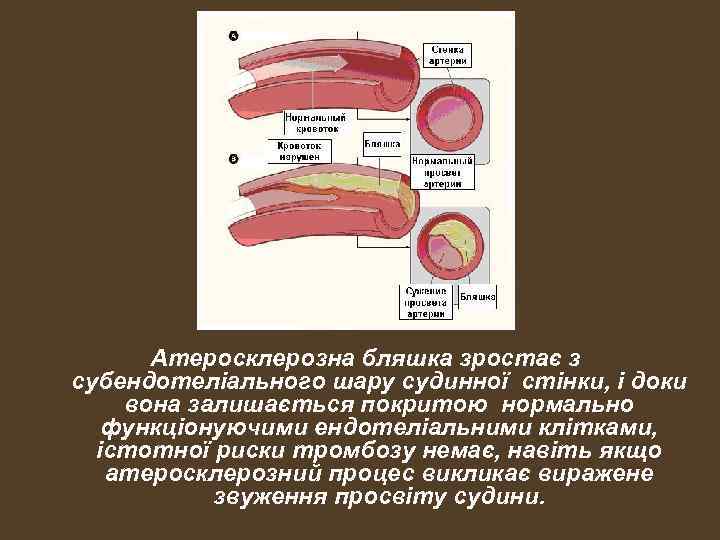 Атеросклерозна бляшка зростає з субендотеліального шару судинної стінки, і доки вона залишається покритою нормально