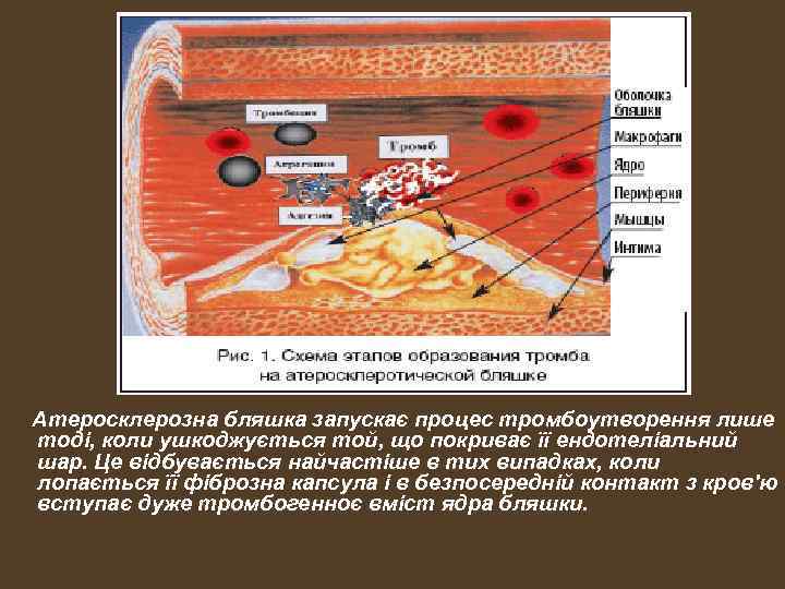 Атеросклерозна бляшка запускає процес тромбоутворення лише тоді, коли ушкоджується той, що покриває її ендотеліальний
