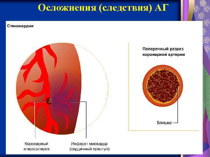 Осложнения (следствия) АГ 1/31/2018 фармакология 10 