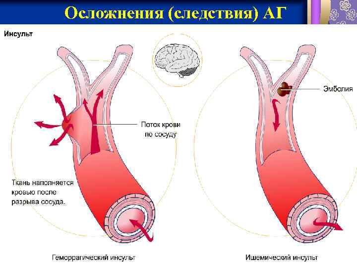 Осложнения (следствия) АГ 1/31/2018 фармакология 12 