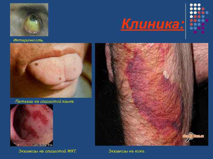 Клиника: Иктеричность. Петехии на слизистой языка. Экхимозы на слизистой ЖКТ. Экхимозы на коже. 