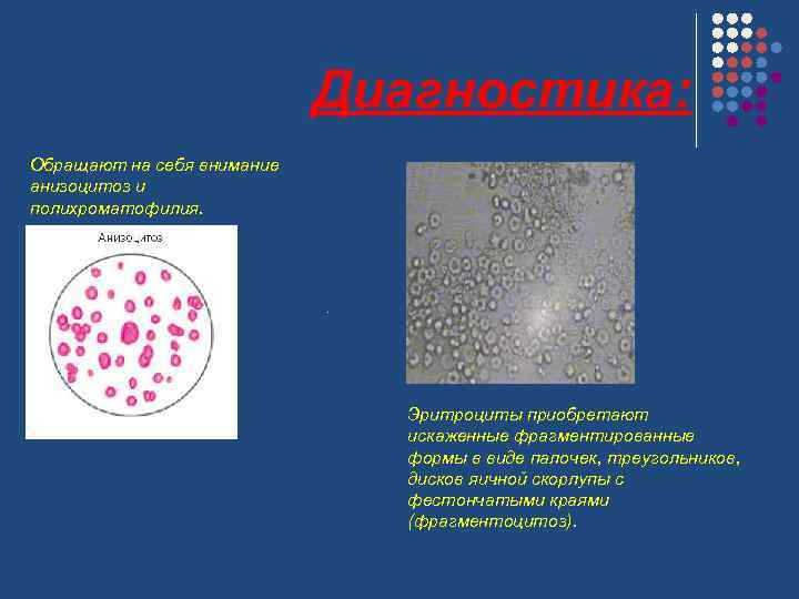 Диагностика: Обращают на себя внимание анизоцитоз и полихроматофилия. . Эритроциты приобретают искаженные фрагментированные формы