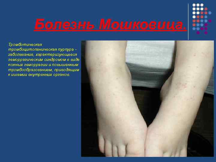 Болезнь Мошковица. Тромботическая тромбоцитопеническая пурпура - заболевание, характеризующееся геморрагическим синдромом в виде кожных геморрагии