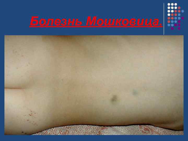 Болезнь Мошковица. 