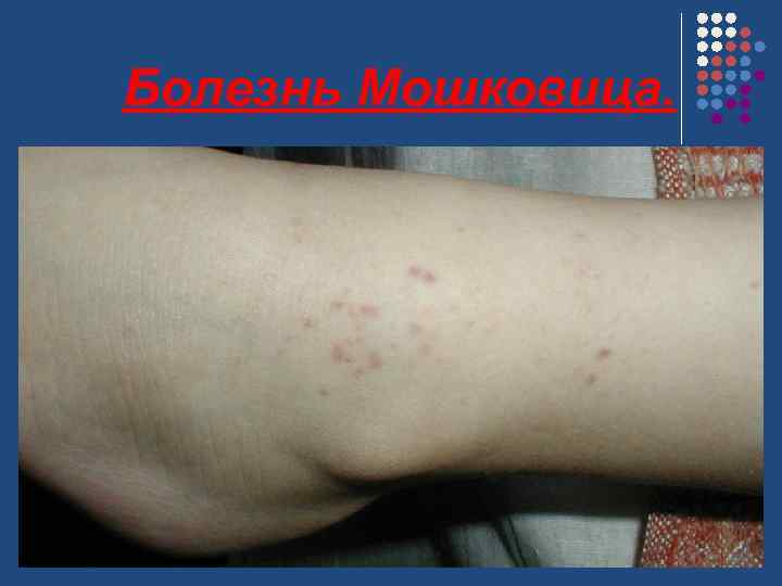 Болезнь Мошковица. 