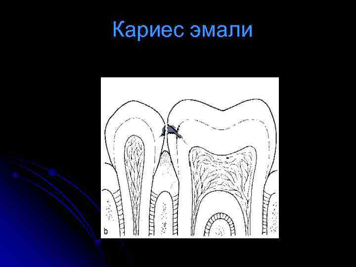 Методы лечения кариеса эмали