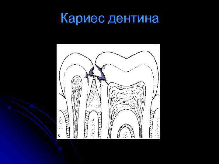 Кариес дентина 