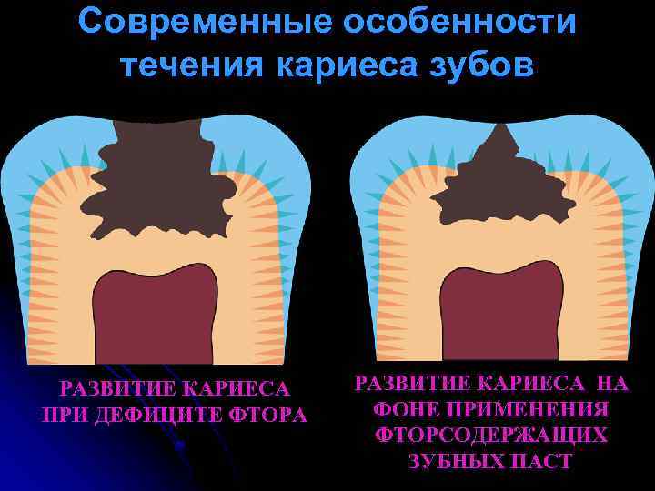 Современные особенности течения кариеса зубов РАЗВИТИЕ КАРИЕСА ПРИ ДЕФИЦИТЕ ФТОРА РАЗВИТИЕ КАРИЕСА НА ФОНЕ