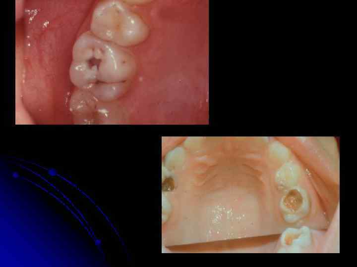 Быстротекущий (острый) кариес у детей 