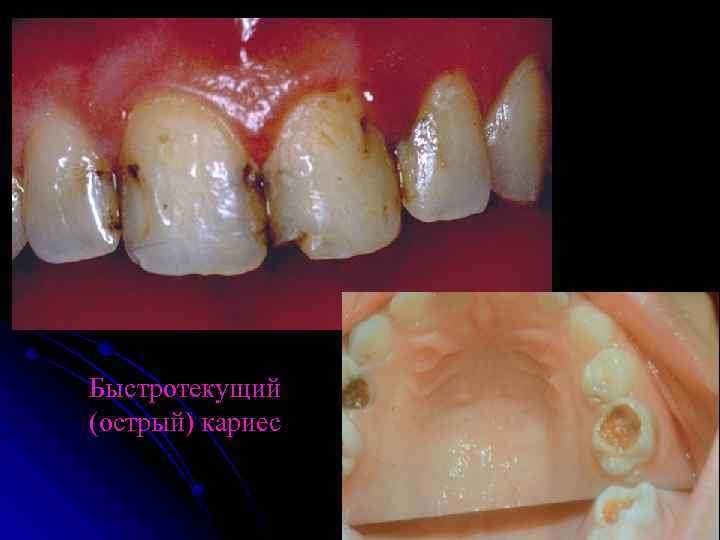 Быстротекущий (острый) кариес 