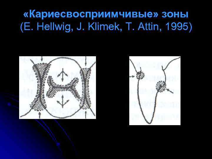  «Кариесвосприимчивые» зоны (E. Hellwig, J. Klimek, T. Attin, 1995) 
