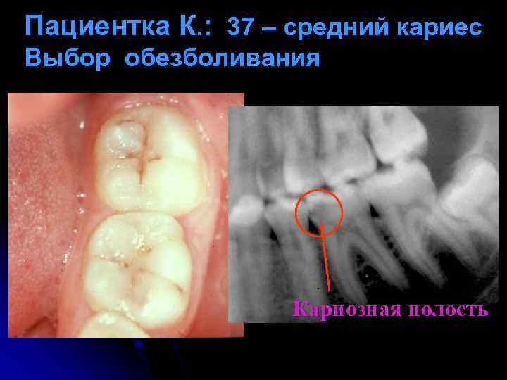 Пациентка К. : 37 – средний кариес Выбор обезболивания Кариозная полость 