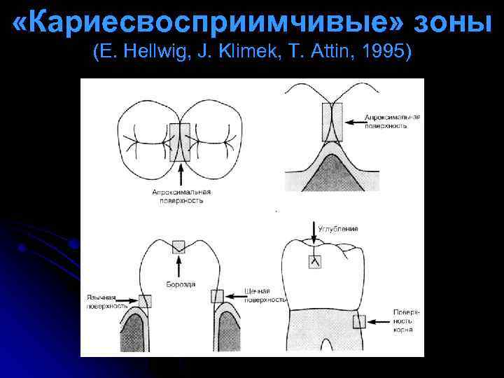  «Кариесвосприимчивые» зоны (E. Hellwig, J. Klimek, T. Attin, 1995) 