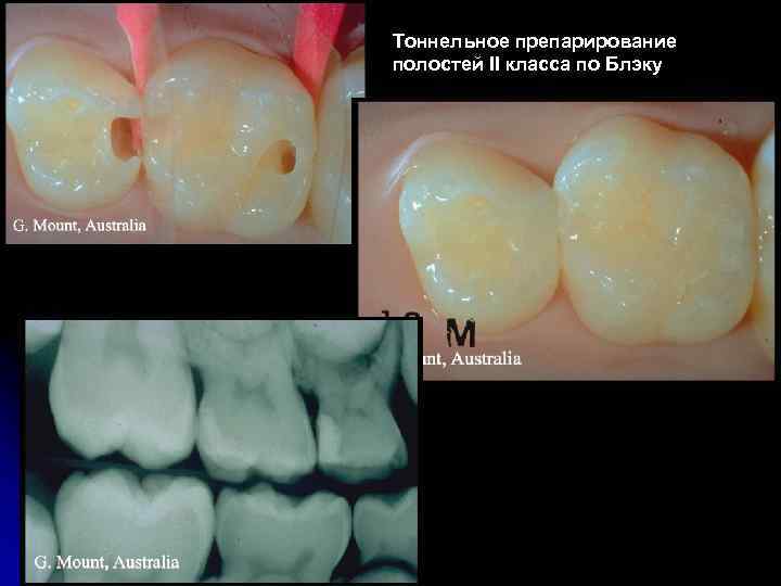 Тоннельное препарирование полостей II класса по Блэку 