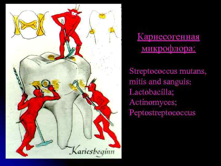 Кариесогенная микрофлора: Streptococcus mutans, mitis and sanguis; Lactobacilla; Actinomyces; Peptostreptococcus 