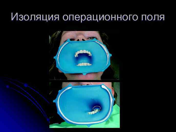 Изоляция операционного поля 