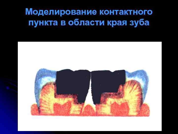 Моделирование контактного пункта в области края зуба 