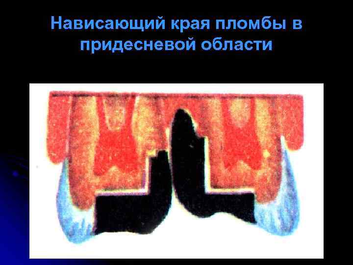 Нависающий края пломбы в придесневой области 