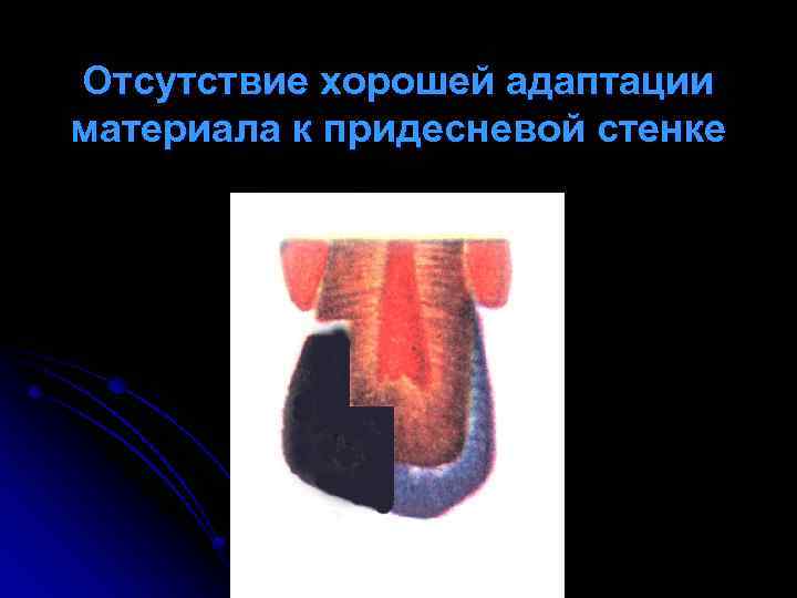 Отсутствие хорошей адаптации материала к придесневой стенке 