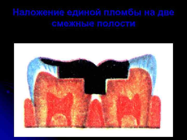 Наложение единой пломбы на две смежные полости 
